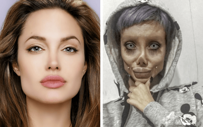 Celeb Obsession Iranian Teen Underwent 50 Surgeries To Look Like